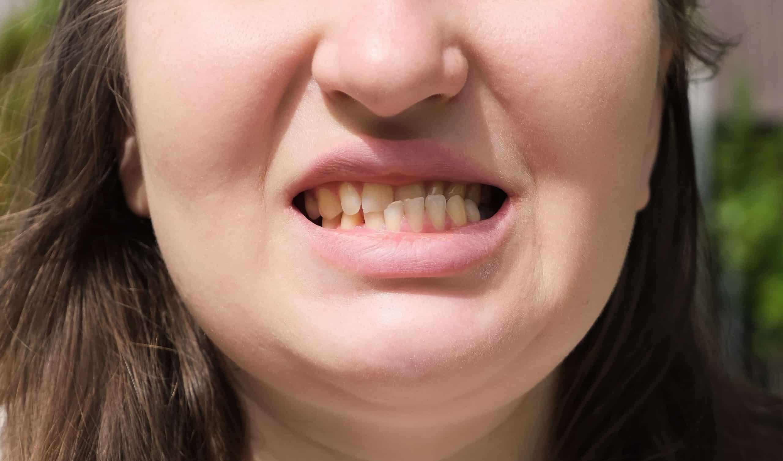Jaw Misaligned Symptoms: Everything You Should Know