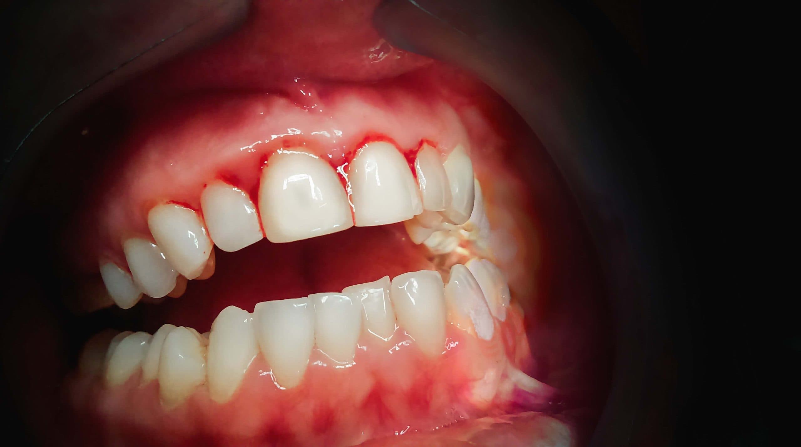 Person experiencing bleeding gums while brushing