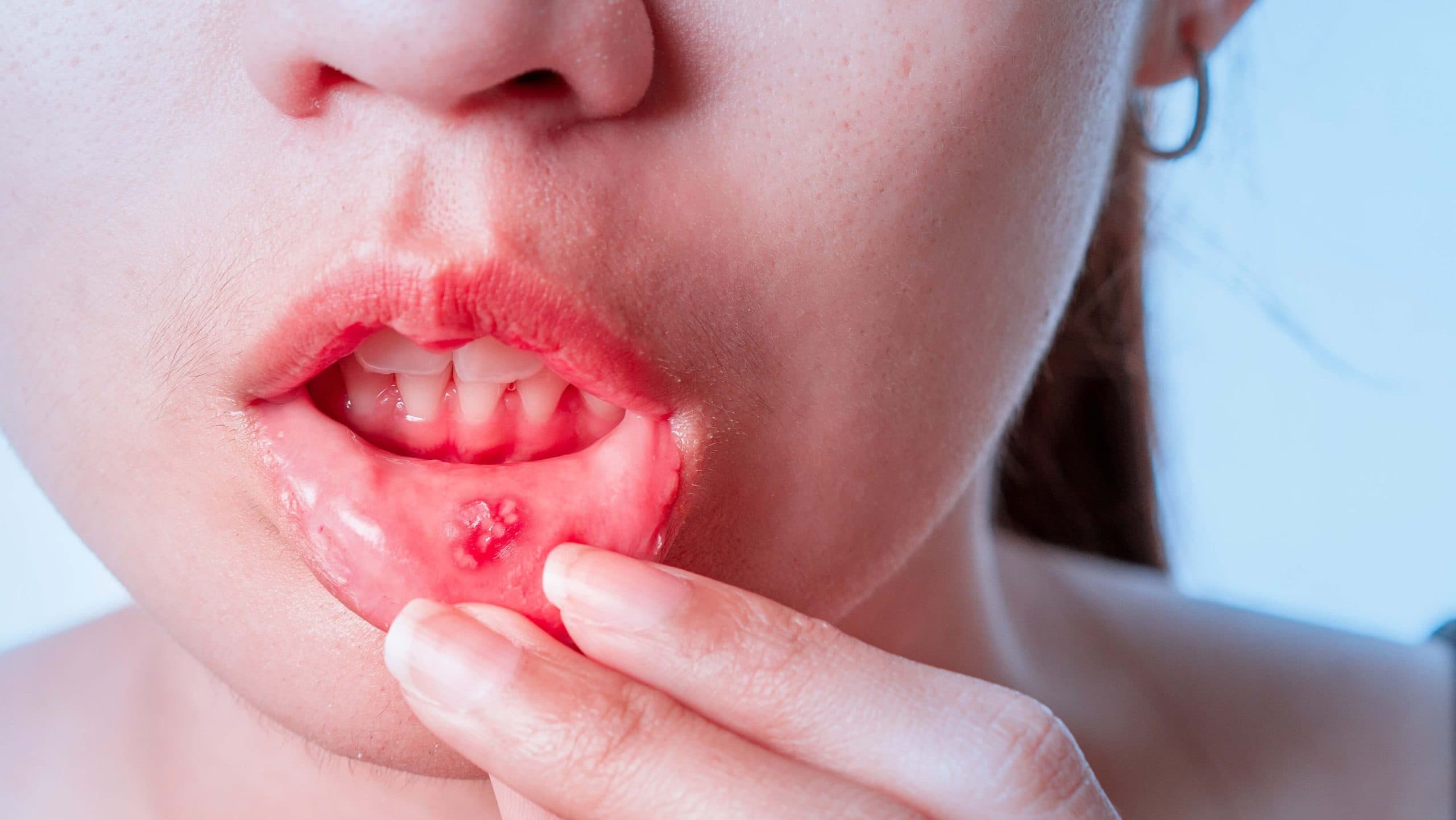 Person experiencing discomfort from a mouth sore