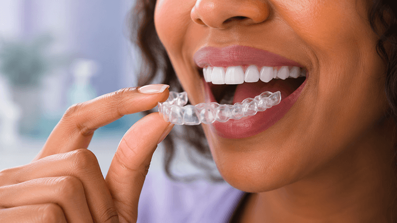 Clear Aligners