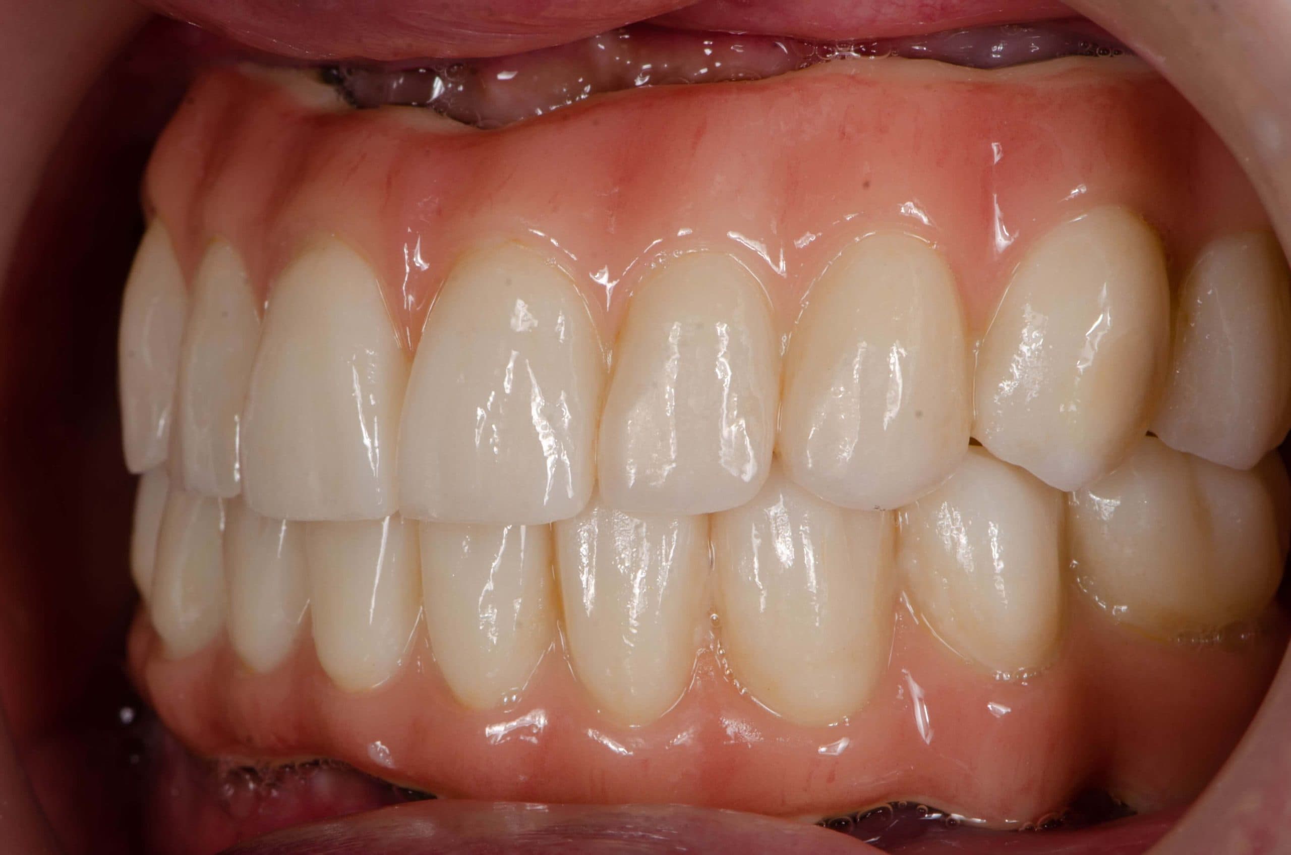 Close-up showing receding gums exposing tooth roots