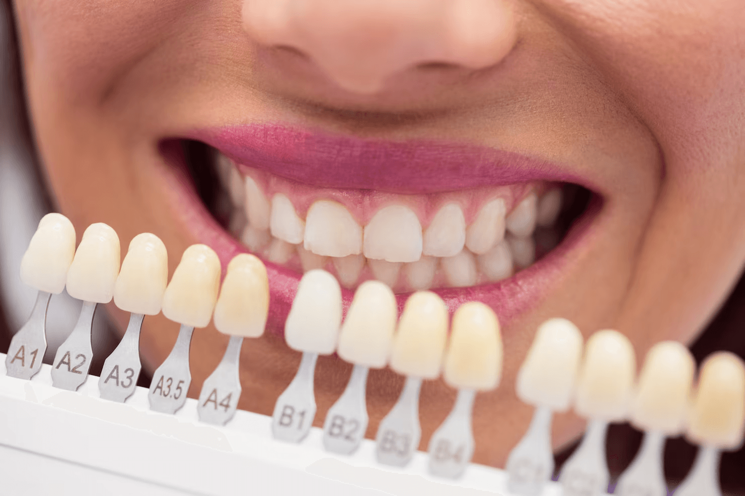 What is a Home Teeth Whitening Kit? Whiten Your Teeth at Home with Dentist Supervision