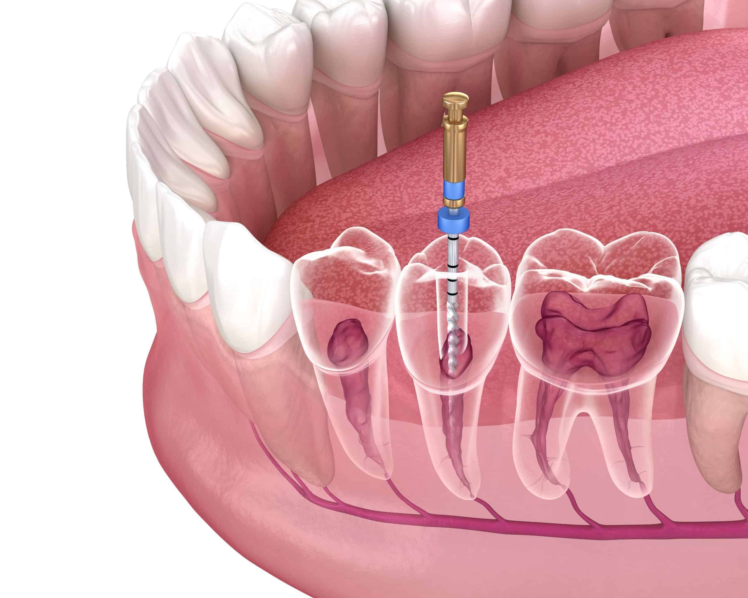 X-ray showing an abscessed wisdom tooth