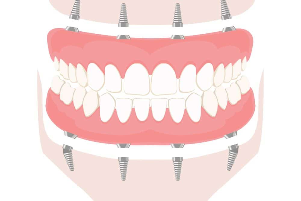Full mouth dental implant model showing complete arch restoration