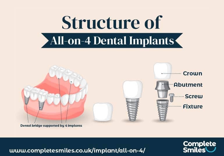 A visual illustration of All-on-4 dental implants with parts named