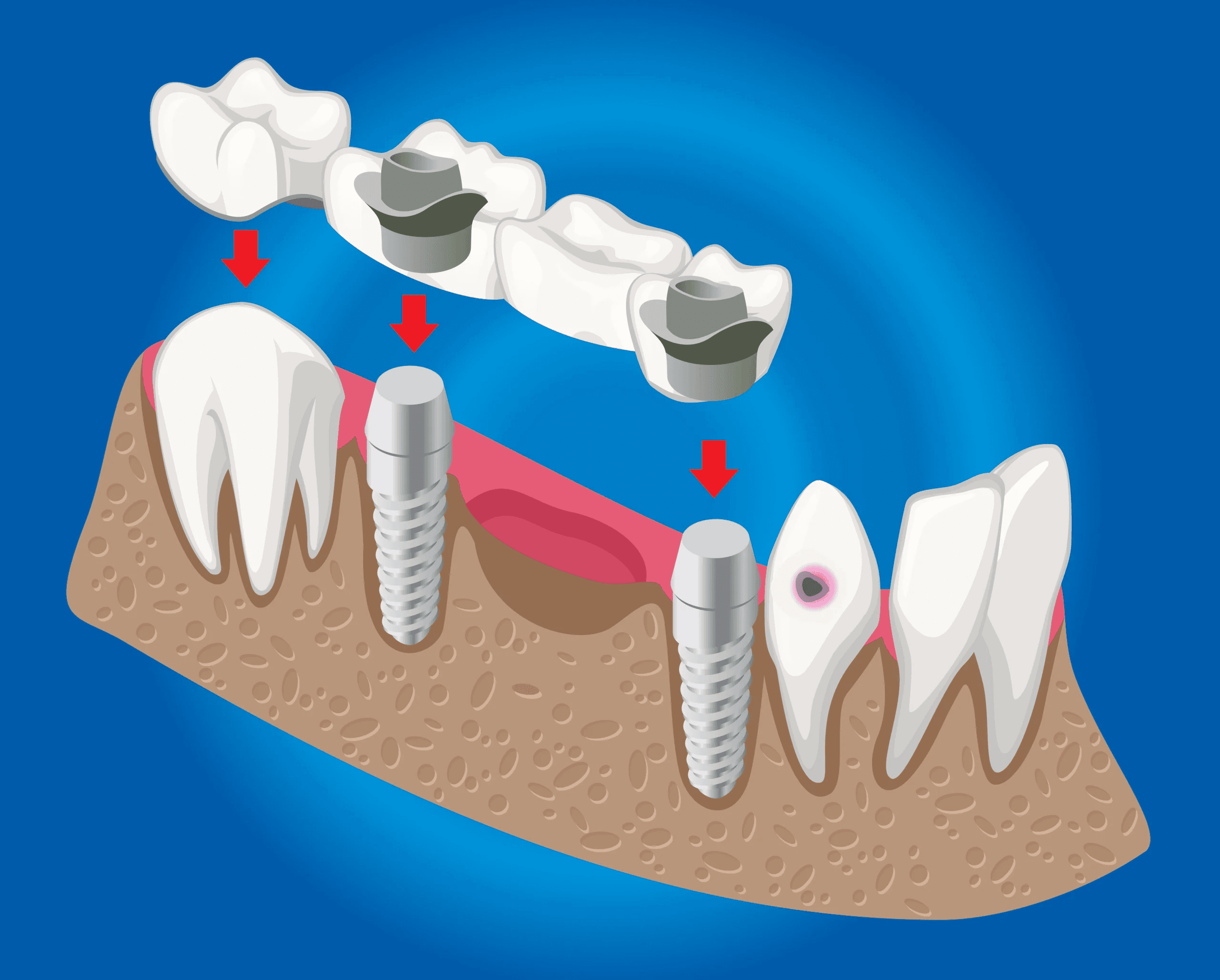 A graphic illustration of how All-on-4 dental implants can be placed inside the mouth from one side.