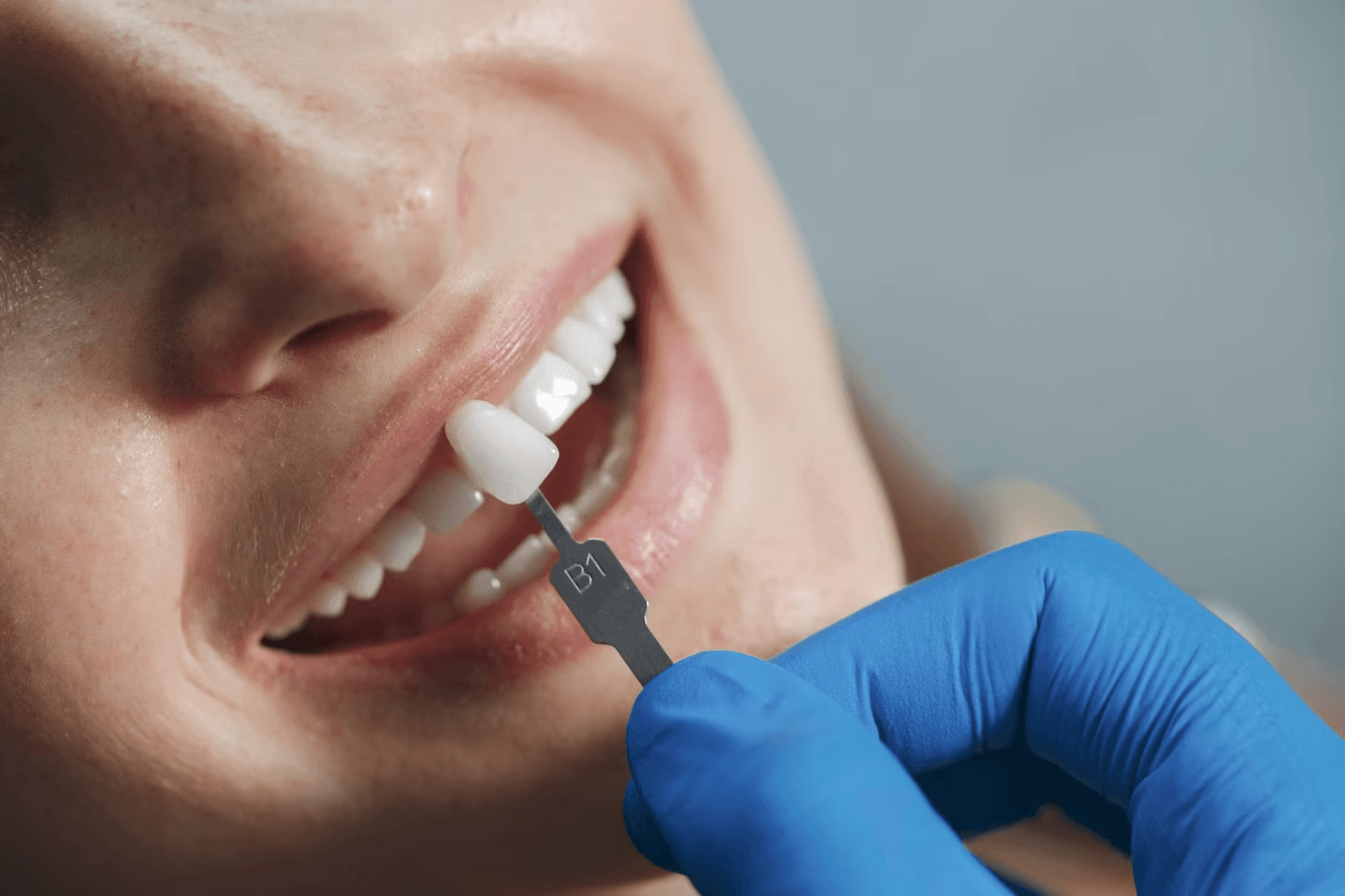 Read This Before You Choose Cheap Composite Bonding in the UK