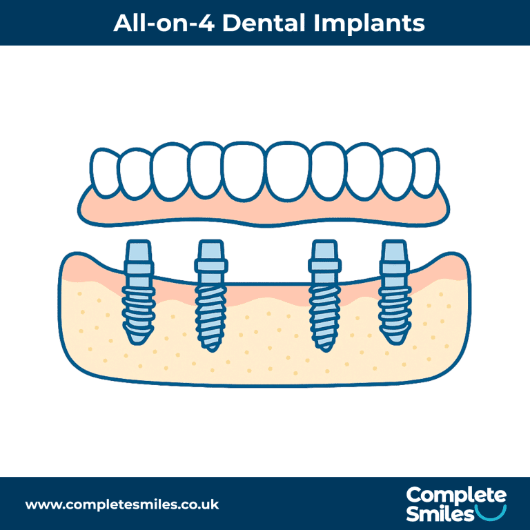 All-on-4 Dental Implants