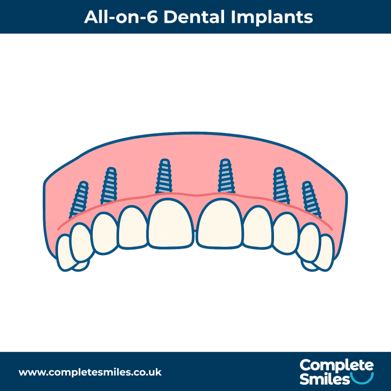 All-on-6 Dental Implants