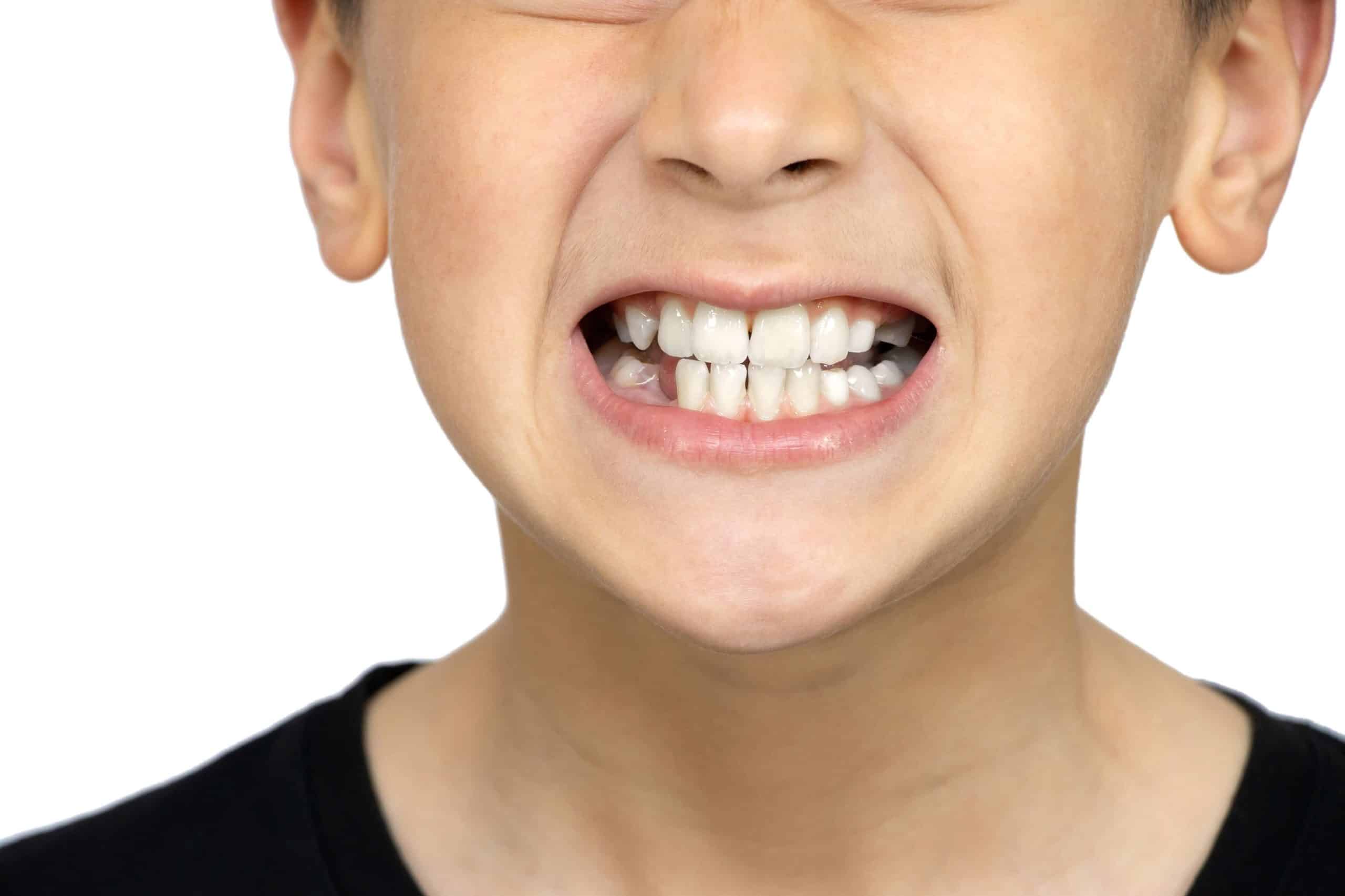 Wisdom tooth signs and symptoms