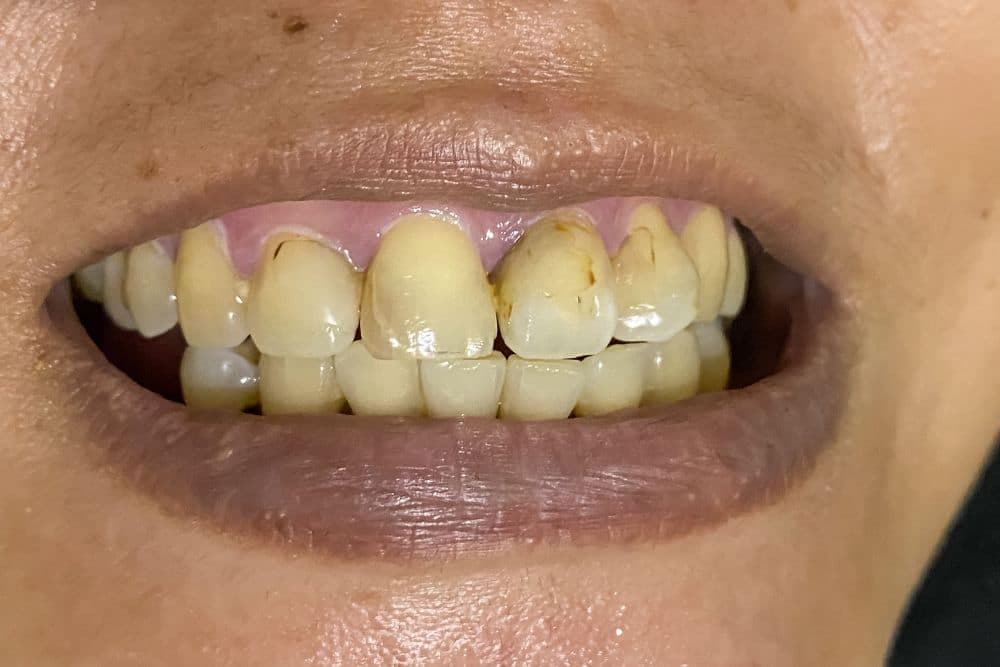 Wisdom tooth signs and symptoms