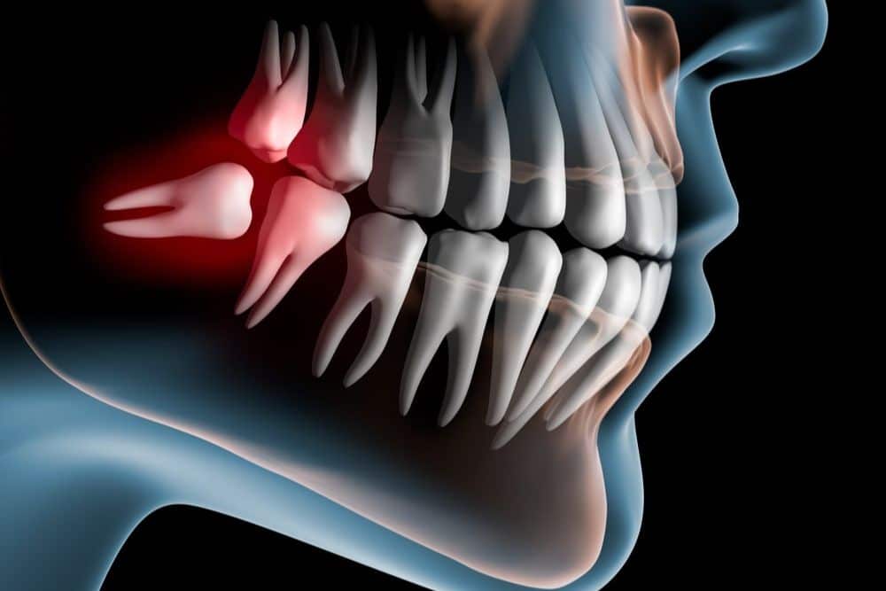 Wisdom teeth extraction and recovery facts