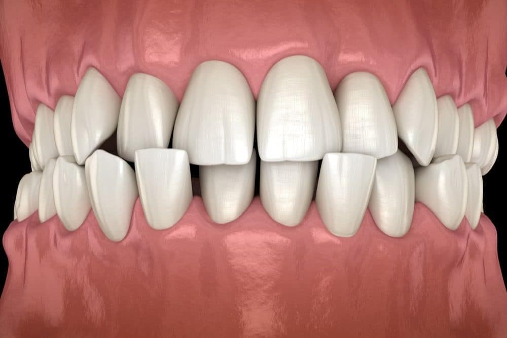 6 Cosmetic Solutions for Misaligned Teeth