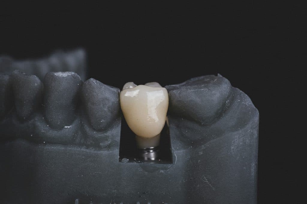 Implants Don’t Get Cavities but Infections Can Still Happen