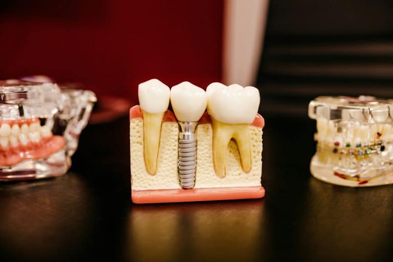 Lesser-Known Facts You Need to Know Before Getting Dental Implants