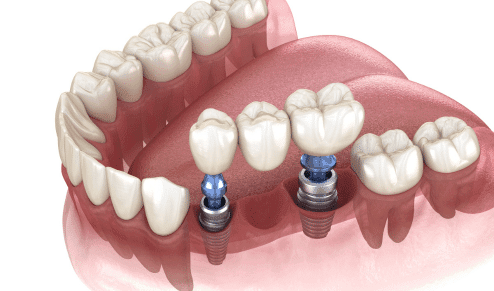 7 Lesser-Known Facts You Need to Know Before Getting Dental Implants