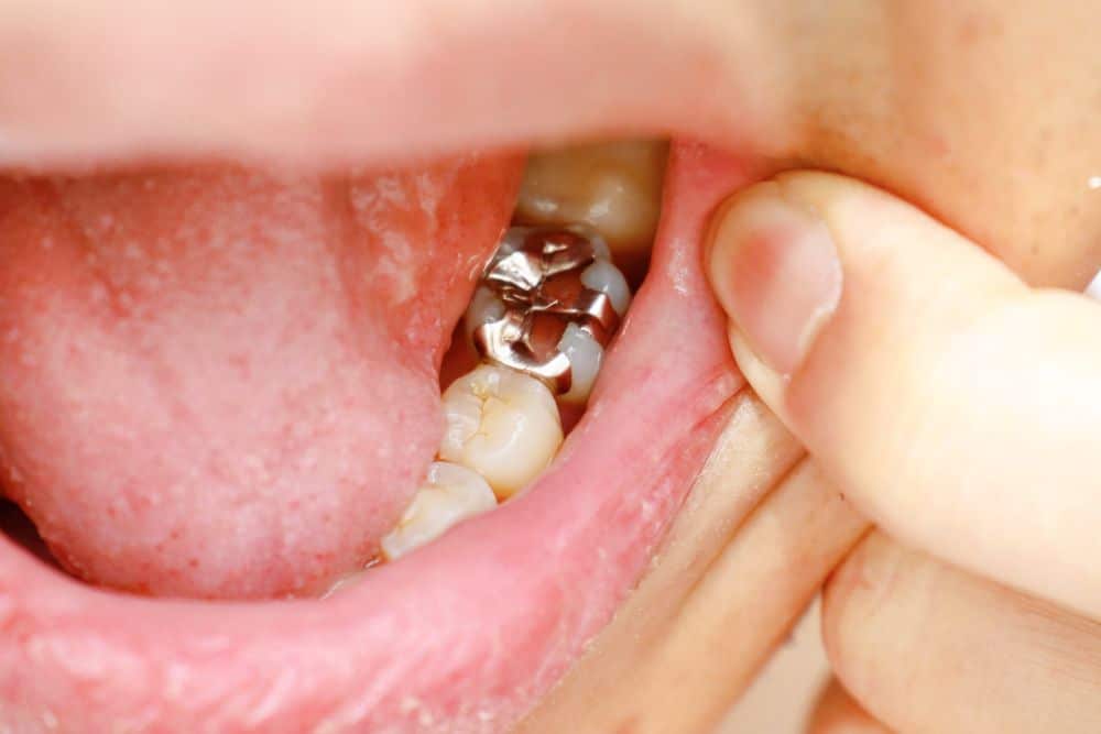 7 Reasons for using Composite Dental Filling