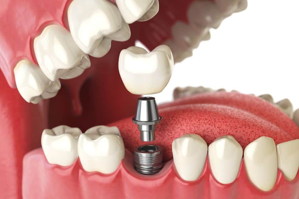 Are Dental Implants Safe? Expert Insights and Patient Experiences