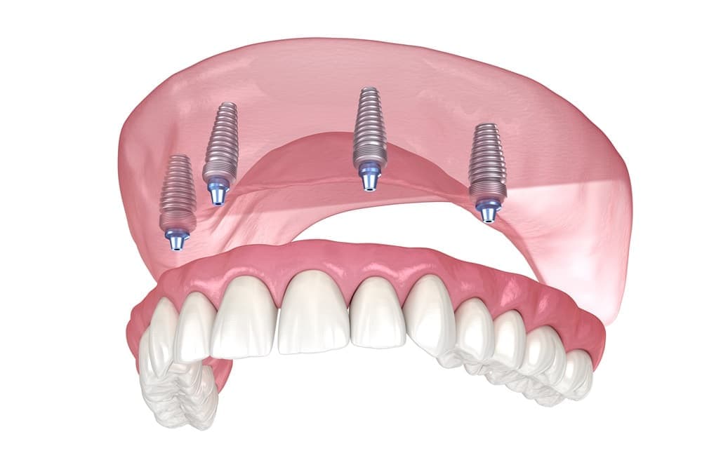 Sinus lift vs zygomatic implants for bone loss