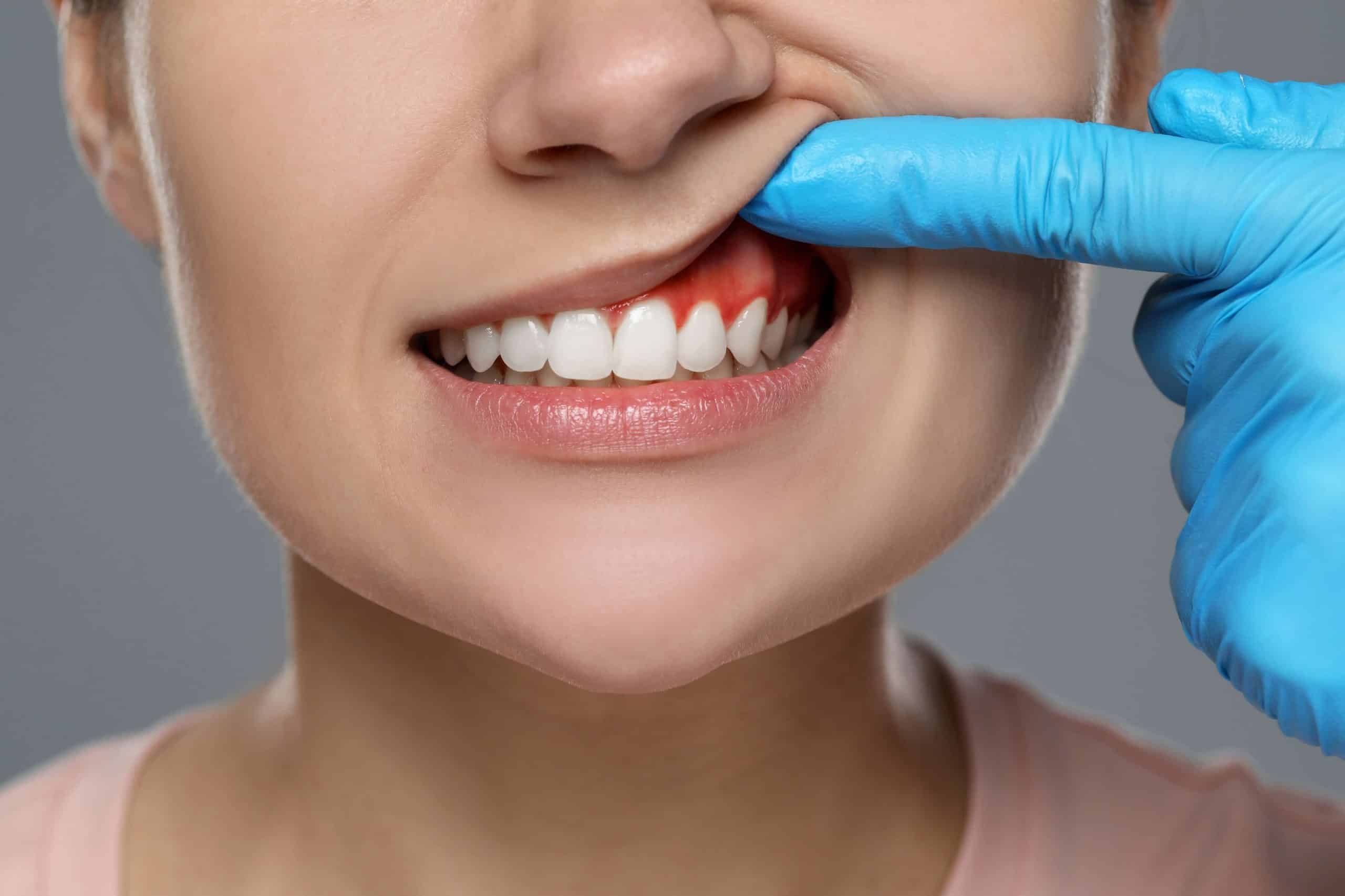 Surprising reasons for bleeding gums