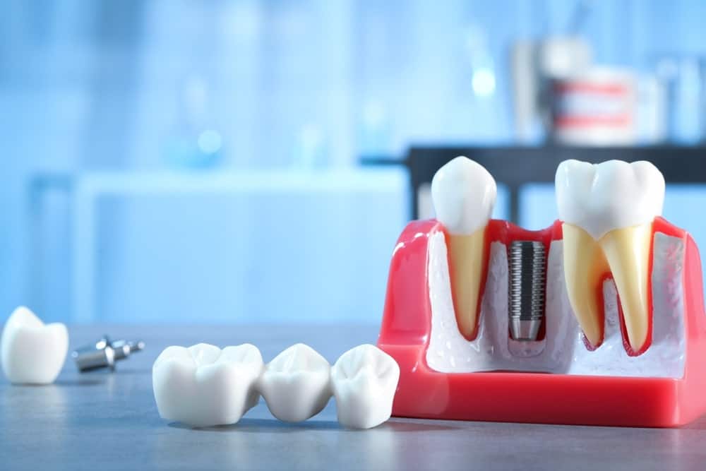 Post-surgery care after dental implants