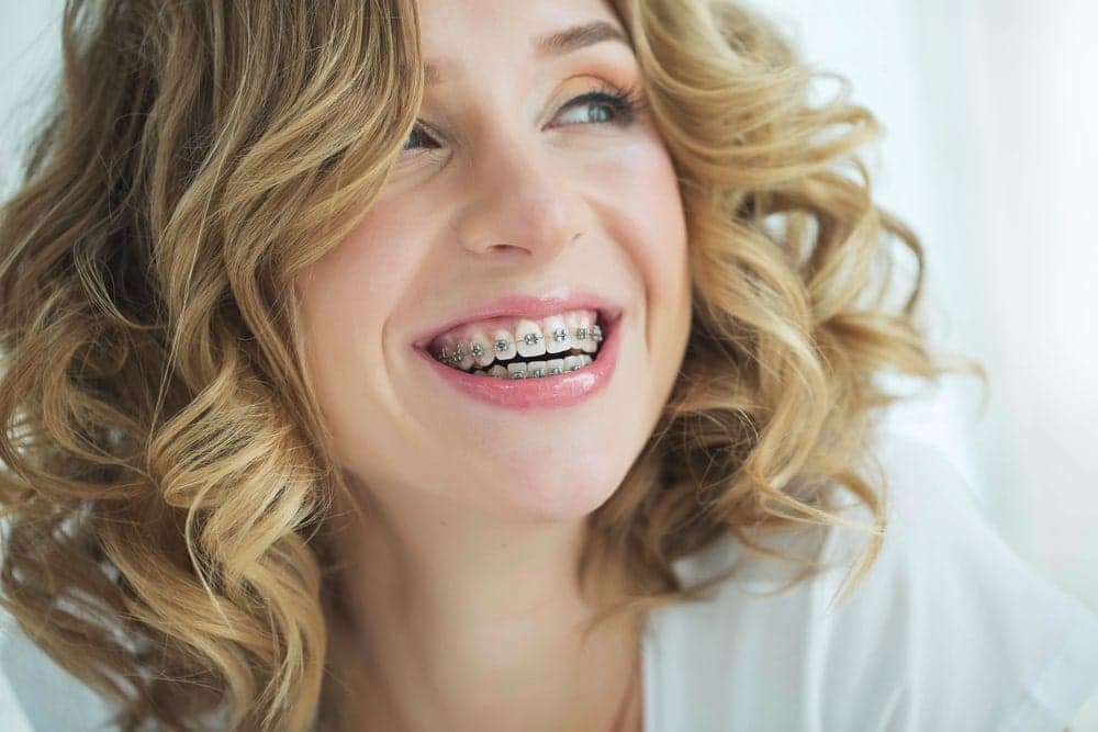 Ceramic braces on teeth