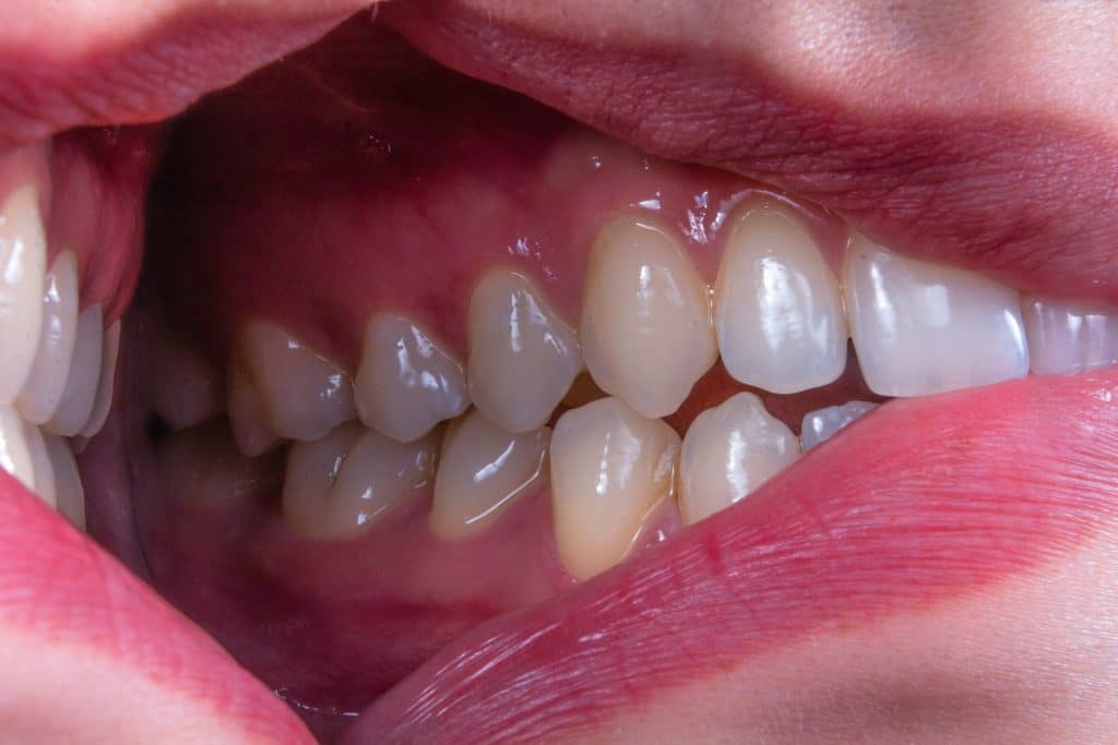 What are the Dental Abscess Types?