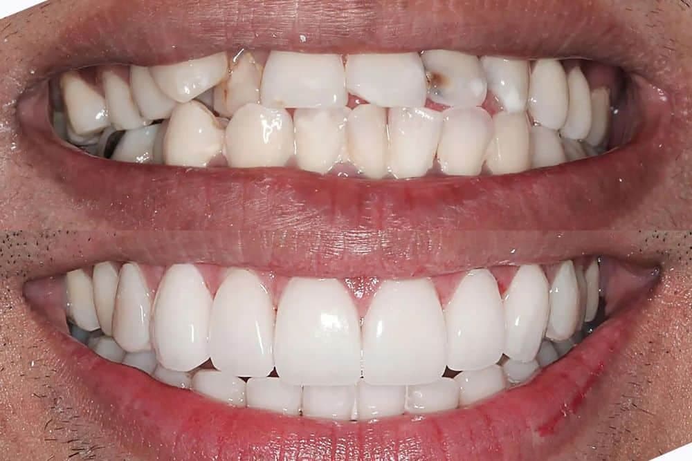 Is Invisalign worth it