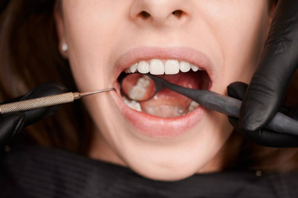 What are the Causes of Dental Erosion