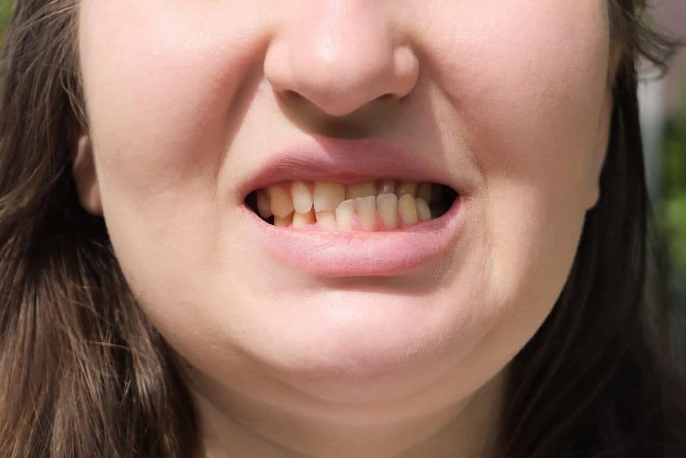 Close-up comparison of a tooth treated with bonding and a tooth fitted with a veneer