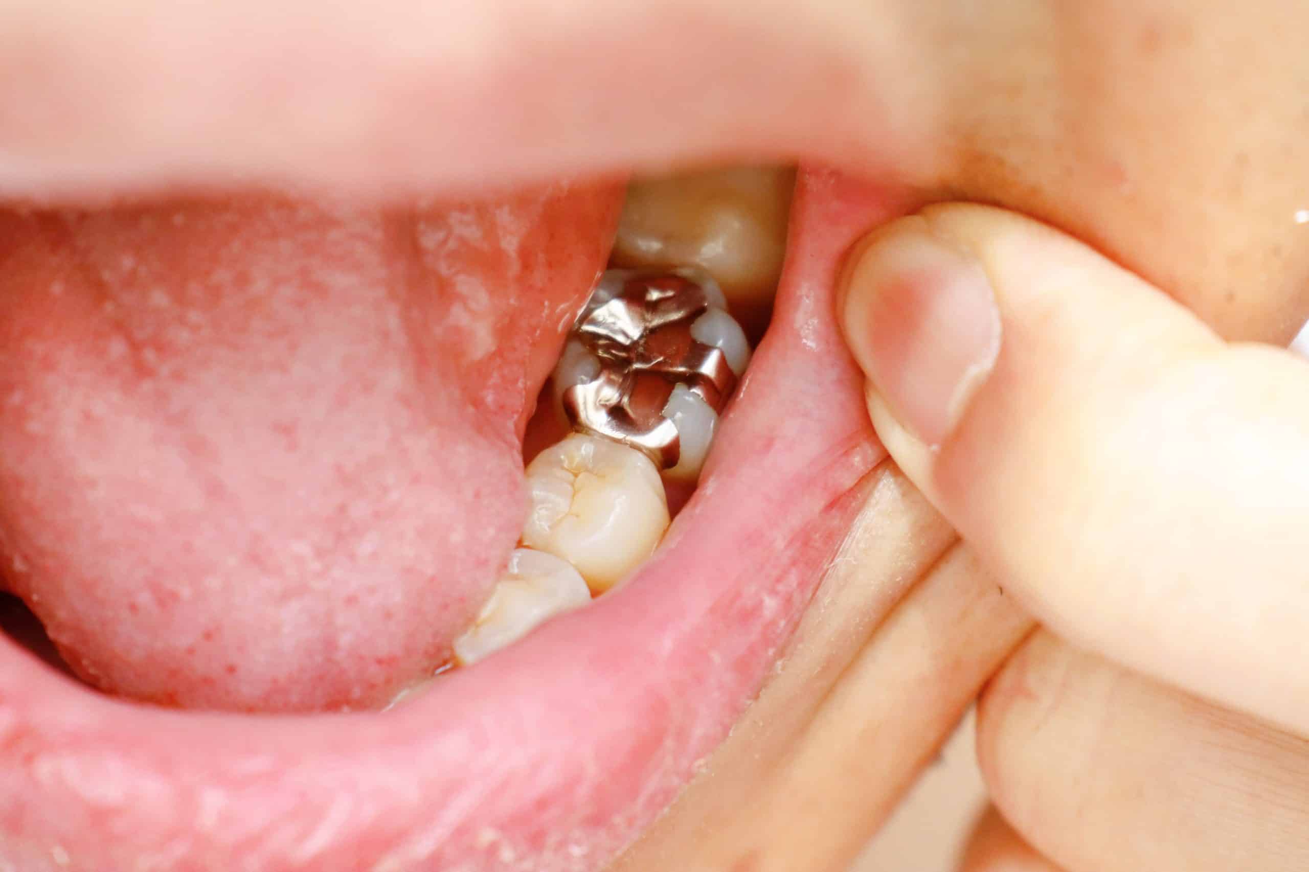 Porcelain dental inlay and onlay restorations beside a tooth model