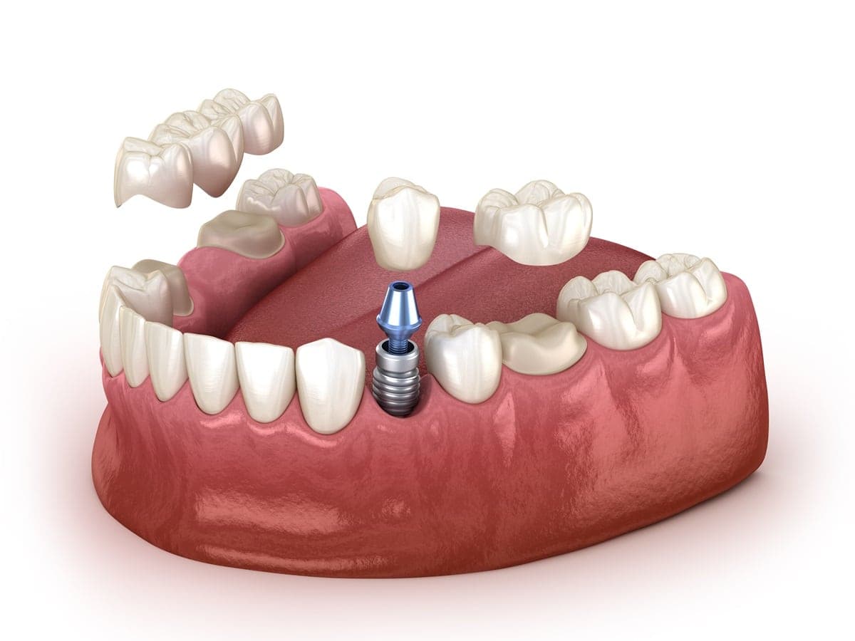Cross-section model of a titanium dental implant placed in the jawbone