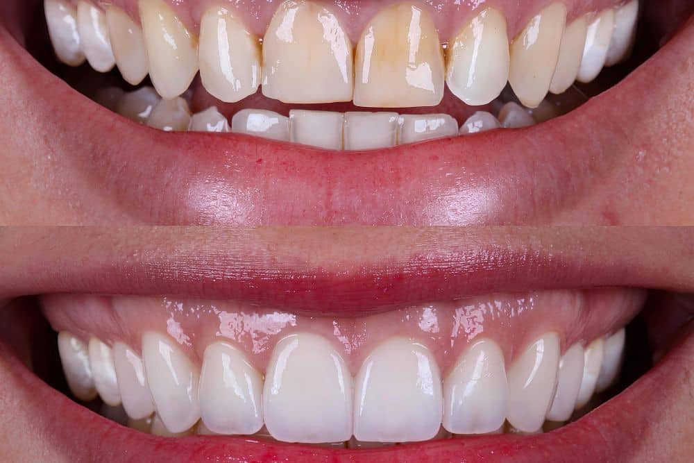 Close-up of stained teeth being compared against a dental shade guide