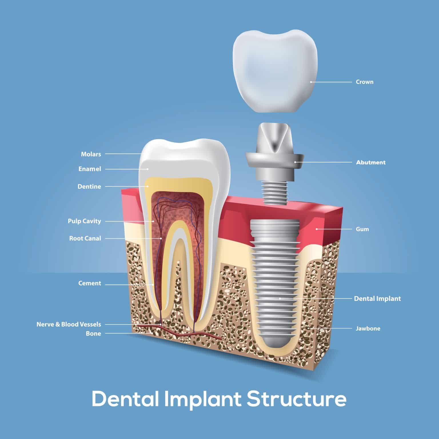 Table showing full mouth implant cost breakdown by type