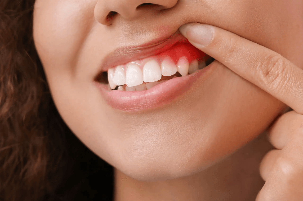 Sore Gums and Mouth: What You Need to Know
