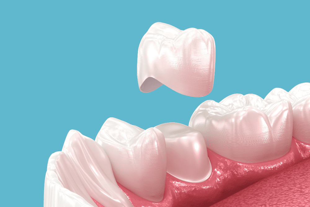 How To Fix A Cracked Tooth?