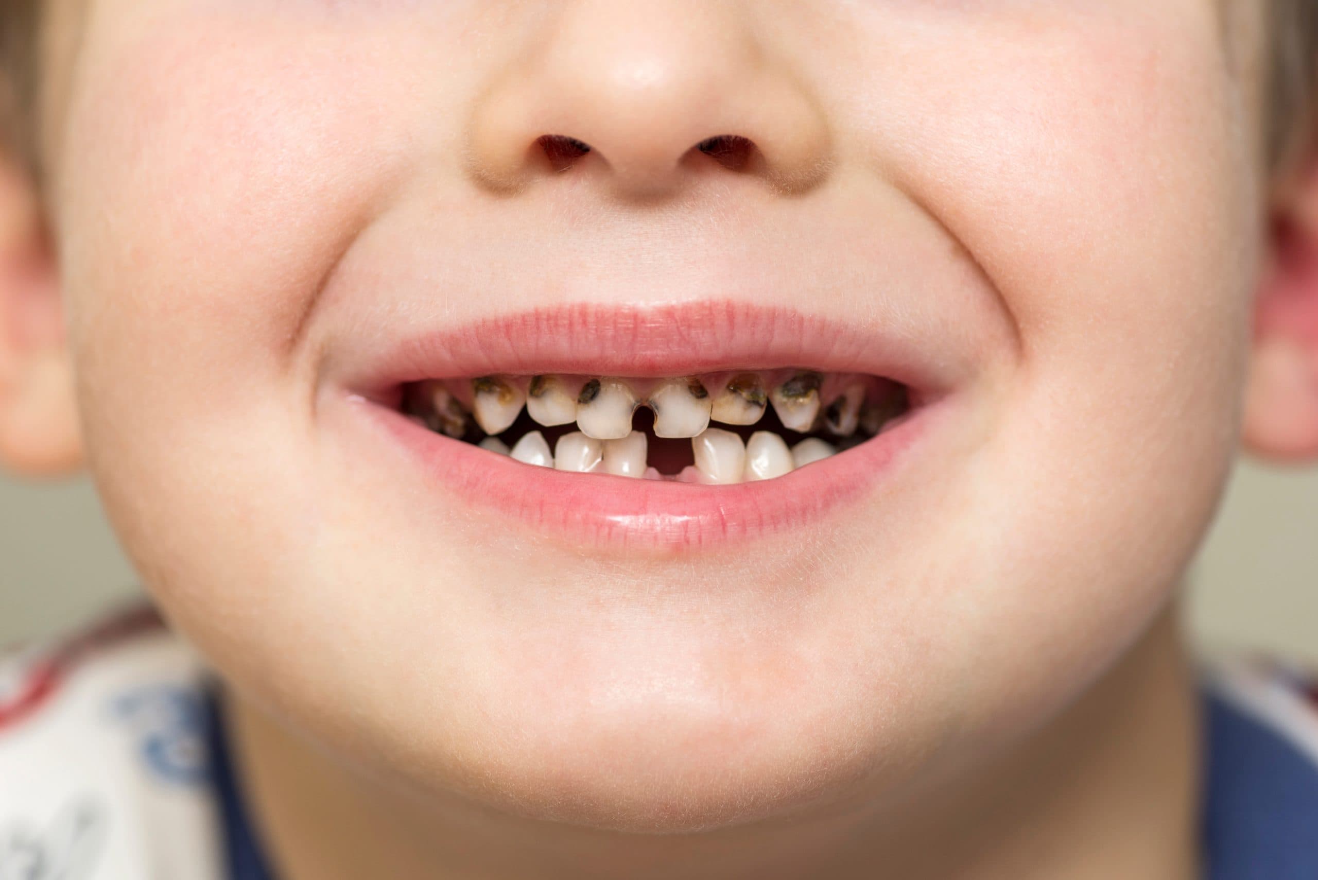 Close-up showing various types of tooth staining