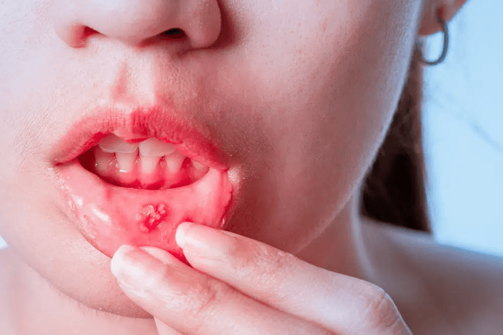 Illustration showing different types of mouth sores