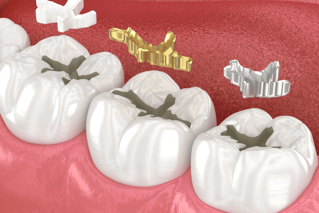 Dentist preparing to perform a cavity filling procedure
