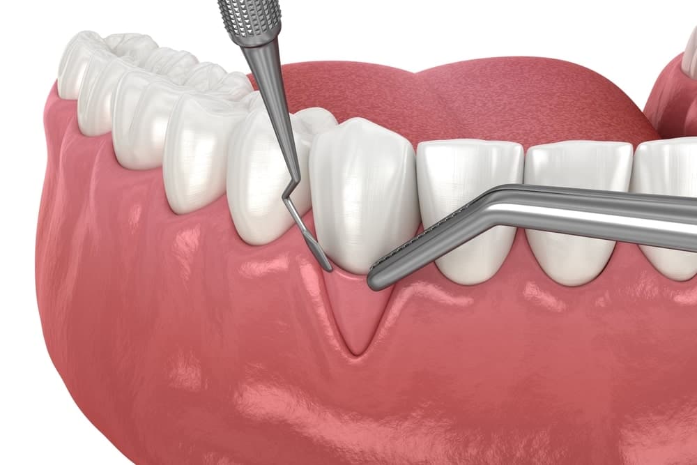 Periodontist preparing for gum graft surgery