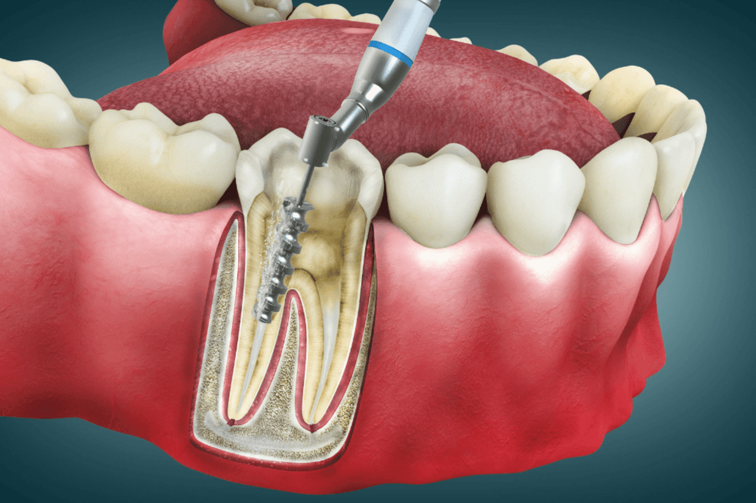 Diagram showing root canal treatment removing infected pulp
