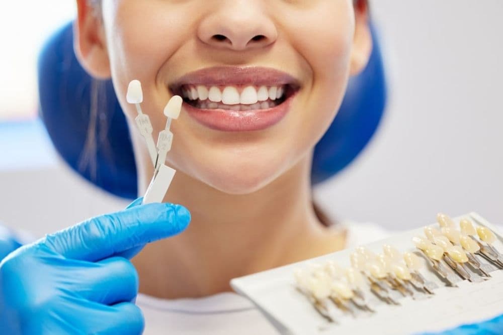 Before and after comparison of dental veneers on front teeth