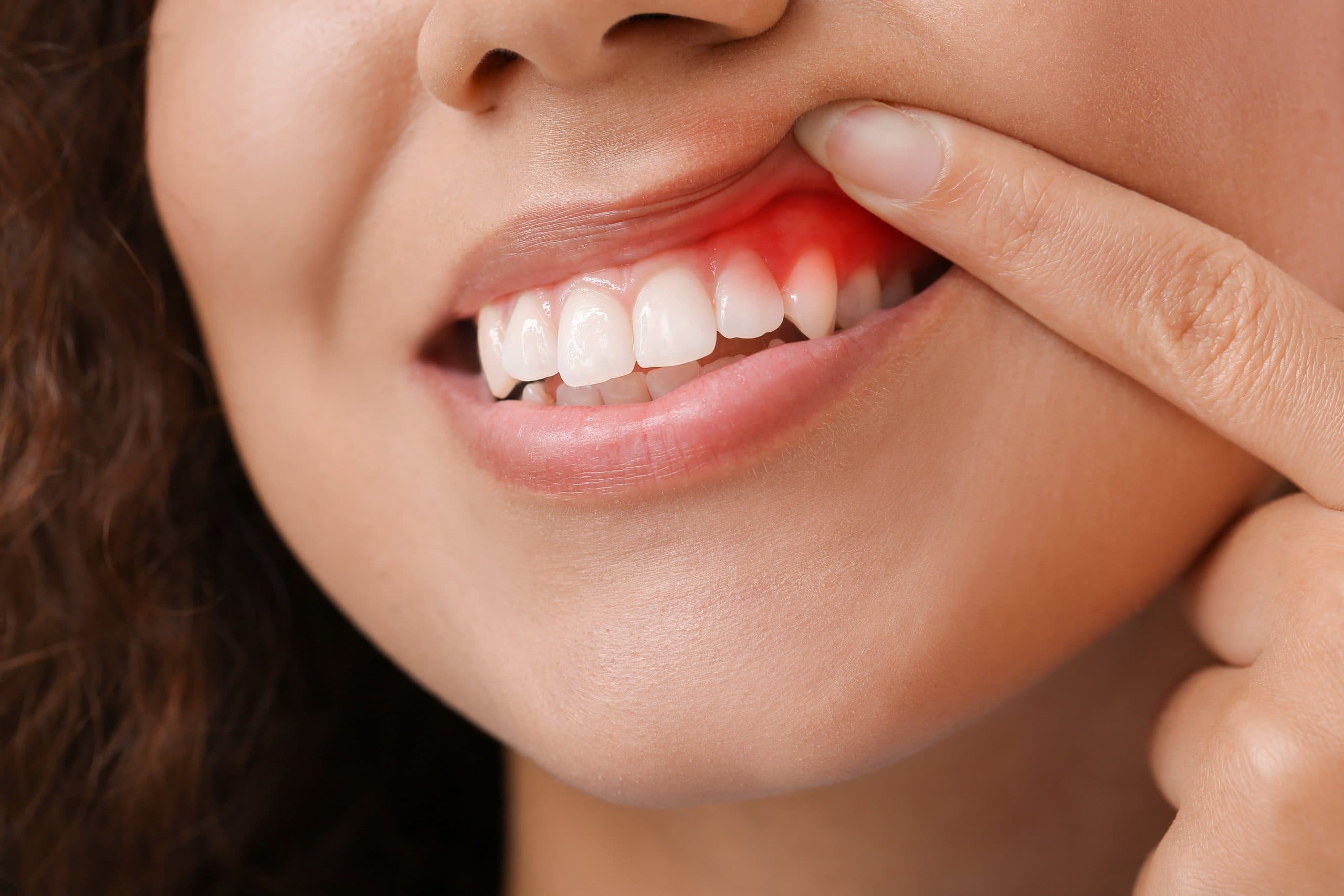 Illustration linking oral bacteria to heart health risks
