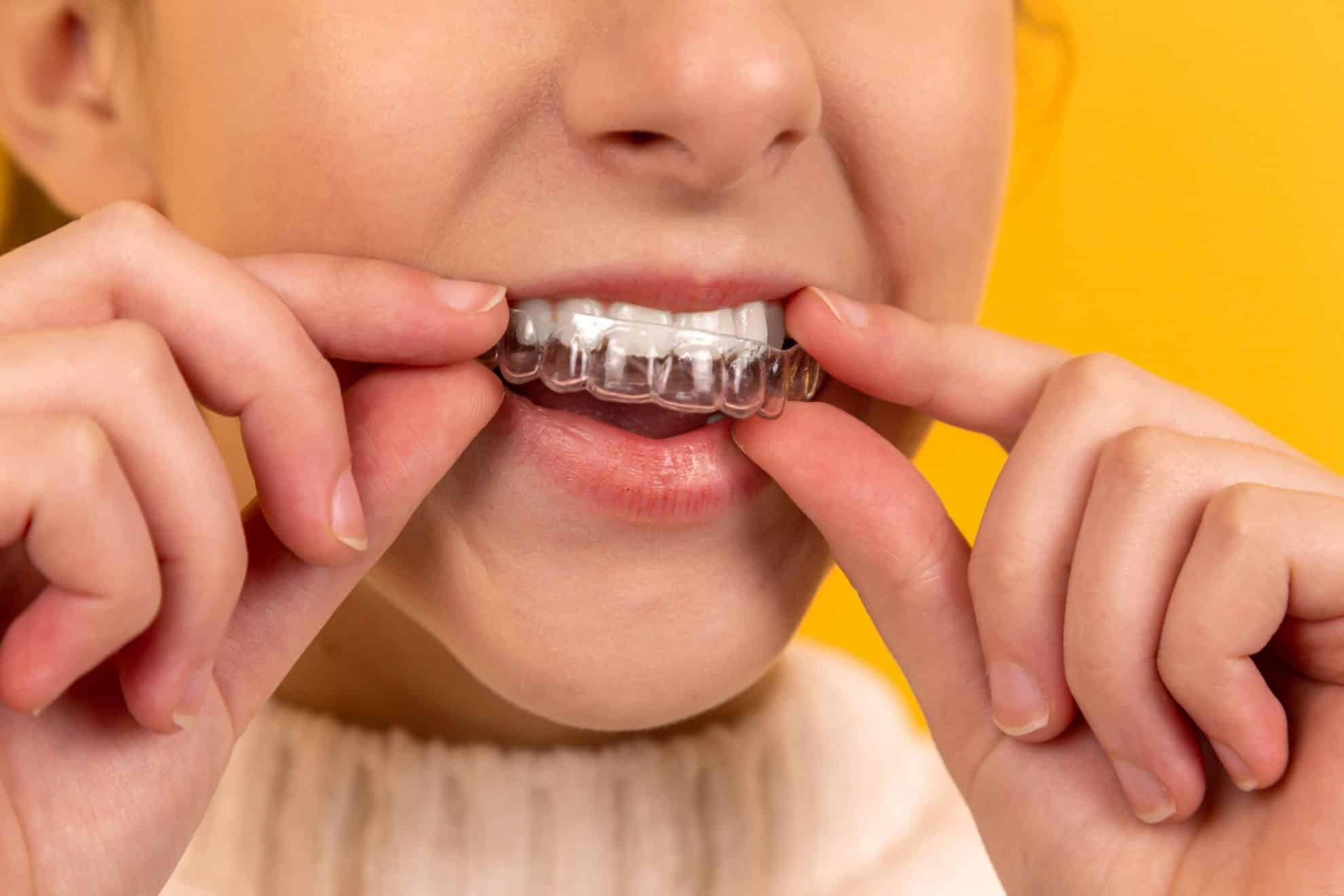 Is Invisalign Suitable for Everyone